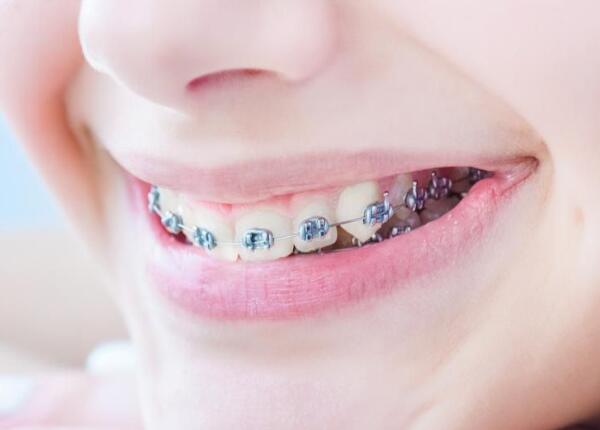 戴了牙套可以用電動(dòng)牙刷嗎？戴牙套的人群必看！