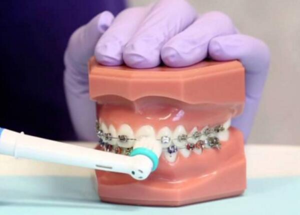 戴了牙套怎么使用電動牙刷？正確使用牙刷很重要