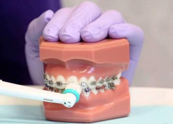 卸了牙套能用電動(dòng)牙刷嗎？答案就在這篇文章